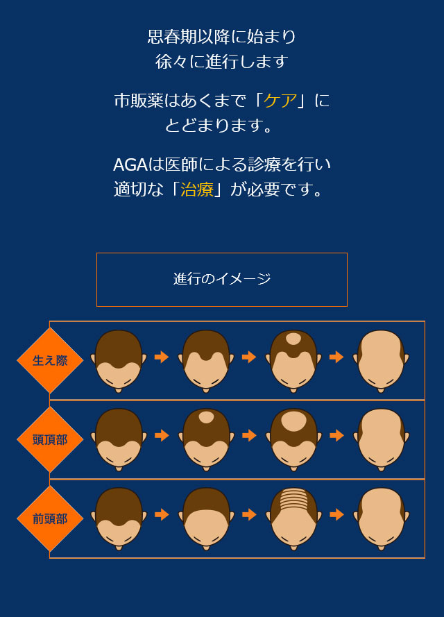 思春期以降に始まり徐々に進行します市販薬はあくまで「ケア」にとどまります。AGAは医師による診療を行い適切な「治療」が必要です。