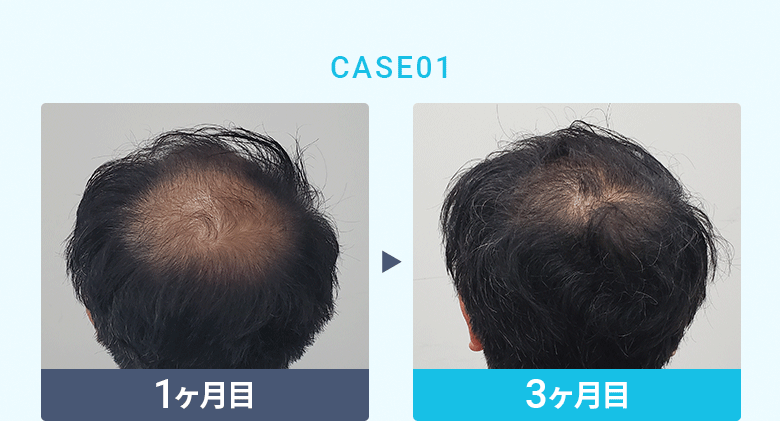 CASE01：【比較写真】1ヶ月目／6ヶ月目