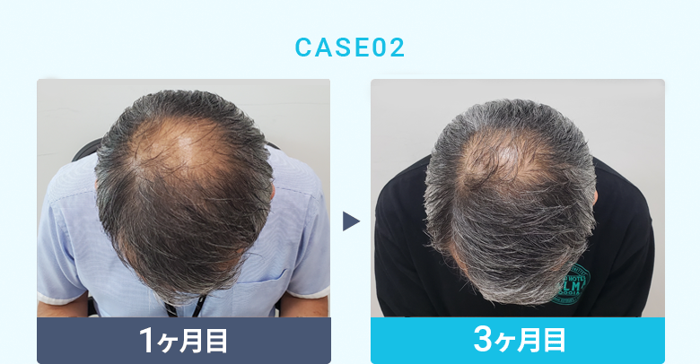 CASE02：【比較写真】1ヶ月目／6ヶ月目