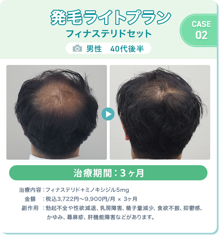
					発毛ライトプラン フィナステリドセット
					男性　40代後半 
					治療期間：３ヶ月 
					治療内容：フィナステリド＋ミノキシジル5mg
					金額：税込3,722円〜9,900円/月 × 3ヶ月
					副作用：勃起不全や性欲減退、乳房障害、精子量減少、食欲不振、抑鬱感、かゆみ、蕁麻疹、肝機能障害などがあります。
					