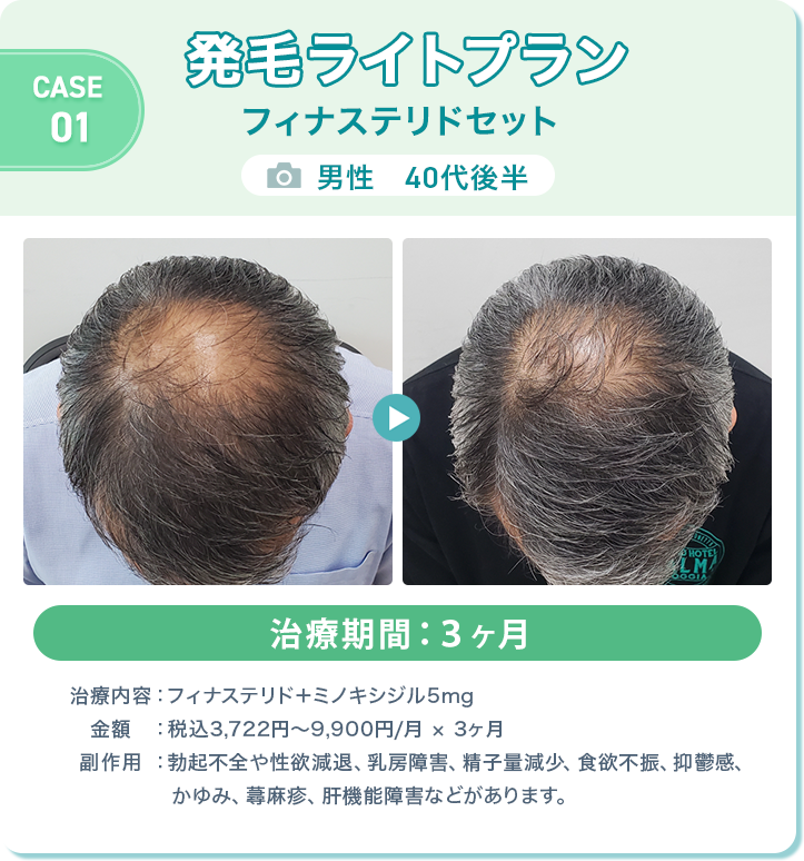 
					発毛ライトプラン フィナステリドセット
					男性　40代後半 
					治療期間：３ヶ月 
					治療内容：フィナステリド＋ミノキシジル5mg
					金額：税込3,722円〜9,900円/月 × 3ヶ月
					副作用：勃起不全や性欲減退、乳房障害、精子量減少、食欲不振、抑鬱感、かゆみ、蕁麻疹、肝機能障害などがあります。
					