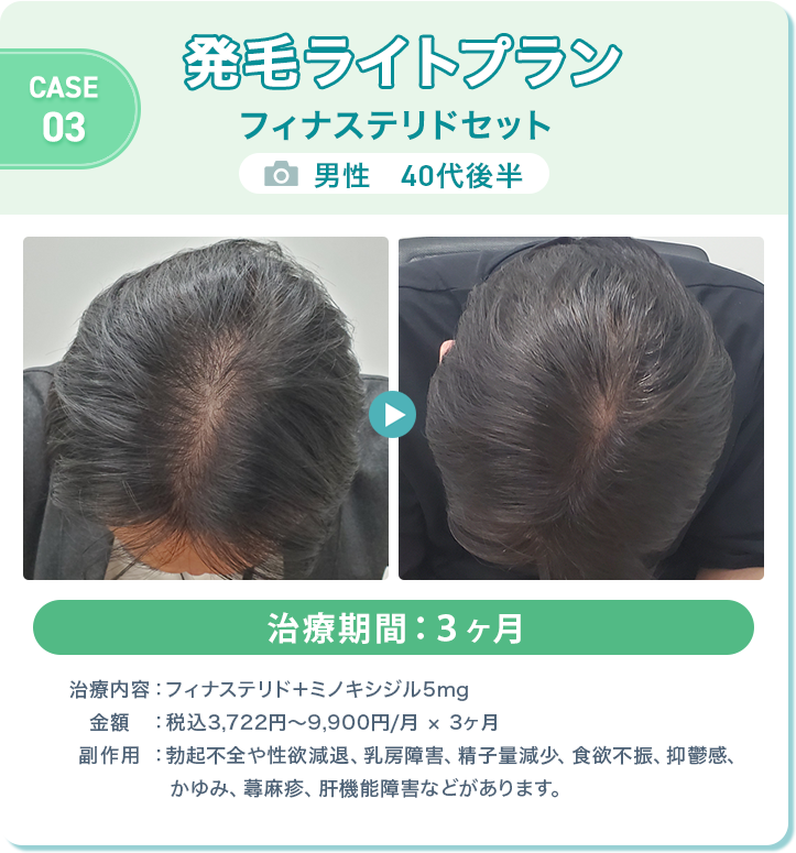 
					発毛ライトプラン フィナステリドセット
					男性　40代後半 
					治療期間：３ヶ月 
					治療内容：フィナステリド＋ミノキシジル5mg
					金額：税込3,722円〜9,900円/月 × 3ヶ月
					副作用：勃起不全や性欲減退、乳房障害、精子量減少、食欲不振、抑鬱感、かゆみ、蕁麻疹、肝機能障害などがあります。
					