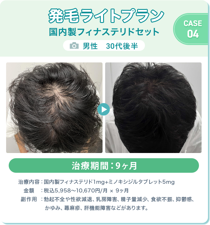 
					発毛ライトプラン 国内製フィナステリドセット
					男性　30代後半 
					治療期間：9ヶ月 
					治療内容：国内製フィナステリド1mg+ミノキシジルタブレット5mg
					金額：税込5,958〜10,670円/月 × 9ヶ月
					副作用：勃起不全や性欲減退、乳房障害、精子量減少、食欲不振、抑鬱感、かゆみ、蕁麻疹、肝機能障害などがあります。
					