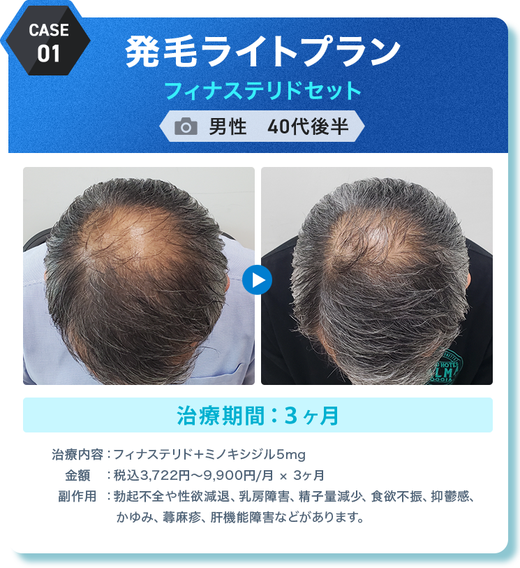 
					発毛ライトプラン フィナステリドセット
					男性　40代後半 
					治療期間：３ヶ月 
					治療内容：フィナステリド＋ミノキシジル5mg
					金額：税込3,722円〜9,900円/月 × 3ヶ月
					副作用：勃起不全や性欲減退、乳房障害、精子量減少、食欲不振、抑鬱感、かゆみ、蕁麻疹、肝機能障害などがあります。
					