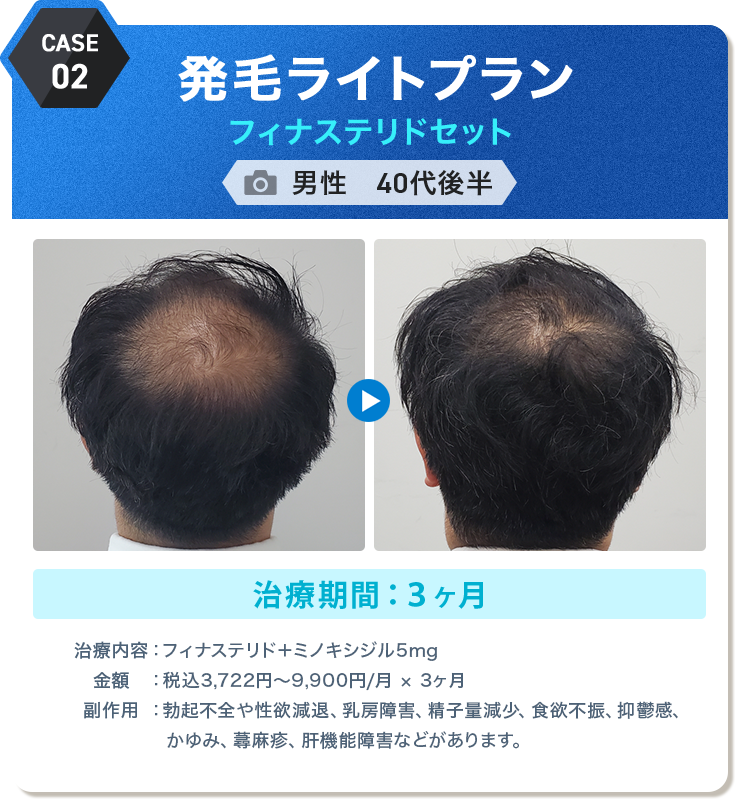 
					発毛ライトプラン フィナステリドセット
					男性　40代後半 
					治療期間：３ヶ月 
					治療内容：フィナステリド＋ミノキシジル5mg
					金額：税込3,722円〜9,900円/月 × 3ヶ月
					副作用：勃起不全や性欲減退、乳房障害、精子量減少、食欲不振、抑鬱感、かゆみ、蕁麻疹、肝機能障害などがあります。
					
