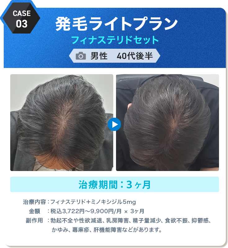 
					発毛ライトプラン フィナステリドセット
					男性　40代後半 
					治療期間：３ヶ月 
					治療内容：フィナステリド＋ミノキシジル5mg
					金額：税込3,722円〜9,900円/月 × 3ヶ月
					副作用：勃起不全や性欲減退、乳房障害、精子量減少、食欲不振、抑鬱感、かゆみ、蕁麻疹、肝機能障害などがあります。
					
