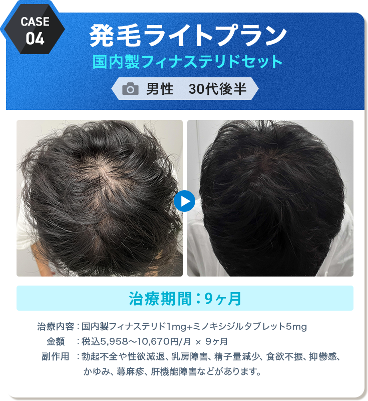 
					発毛ライトプラン 国内製フィナステリドセット
					男性　30代後半 
					治療期間：9ヶ月 
					治療内容：国内製フィナステリド1mg+ミノキシジルタブレット5mg
					金額：税込5,958〜10,670円/月 × 9ヶ月
					副作用：勃起不全や性欲減退、乳房障害、精子量減少、食欲不振、抑鬱感、かゆみ、蕁麻疹、肝機能障害などがあります。
					