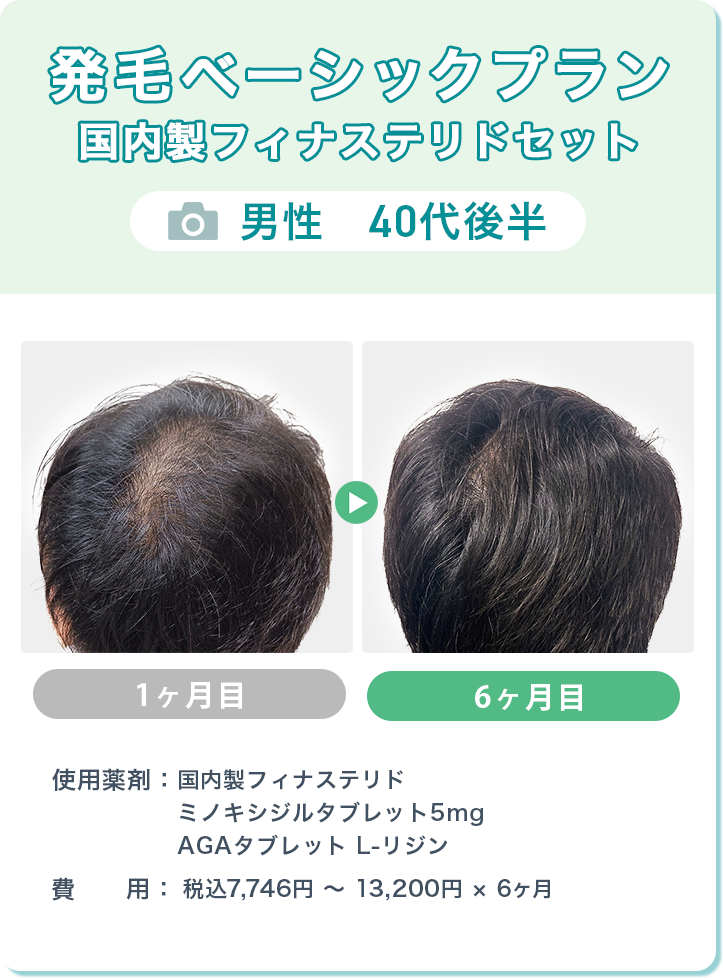 
				発毛ベーシックプラン 国内製フィナステリドセット
				男性　40代後半  
				国内製フィナステリド/ミノキシジルタブレット5mg/AGAタブレット L-リジン
				費用：税込7,746円～13,200円 × 6ヶ月