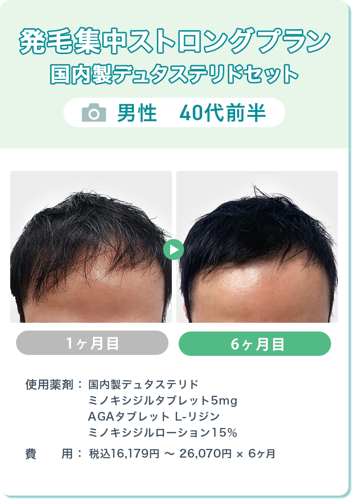 
				発毛集中ストロングプラン 国内製デュタステリドセット 
				男性　40代前半  
				国内製デュタステリド/ミノキシジルタブレット5mg/AGAタブレット L-リジン/ミノキシジルローション15％  
				費用：税込16,179円～26,070円 × 6ヶ月