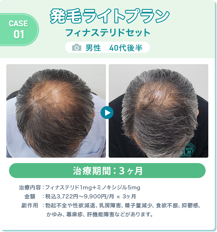
				発毛ライトプラン フィナステリドセット
				男性　40代後半 
				治療期間：3ヶ月
				治療内容：フィナステリド1mg＋ミノキシジル5mg
				金額：税込3,722円〜9,900円/月 × 3ヶ月
				副作用：勃起不全や性欲減退、乳房障害、精子量減少、食欲不振、抑鬱感、かゆみ、蕁麻疹、肝機能障害などがあります。