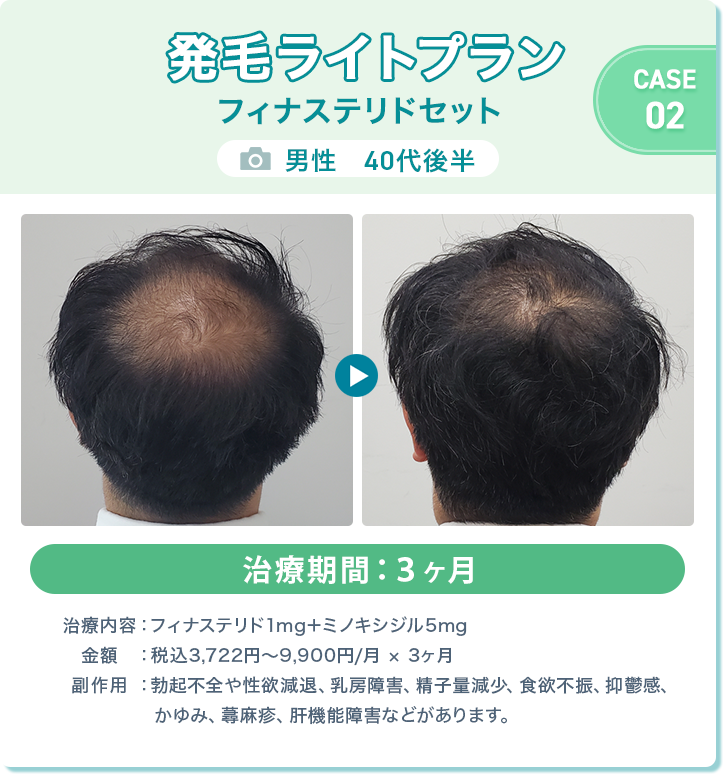 
				発毛ライトプラン フィナステリドセット
				男性　40代後半 
				治療期間：3ヶ月
				治療内容：フィナステリド1mg＋ミノキシジル5mg
				金額：税込3,722円〜9,900円/月 × 3ヶ月
				副作用：勃起不全や性欲減退、乳房障害、精子量減少、食欲不振、抑鬱感、かゆみ、蕁麻疹、肝機能障害などがあります。