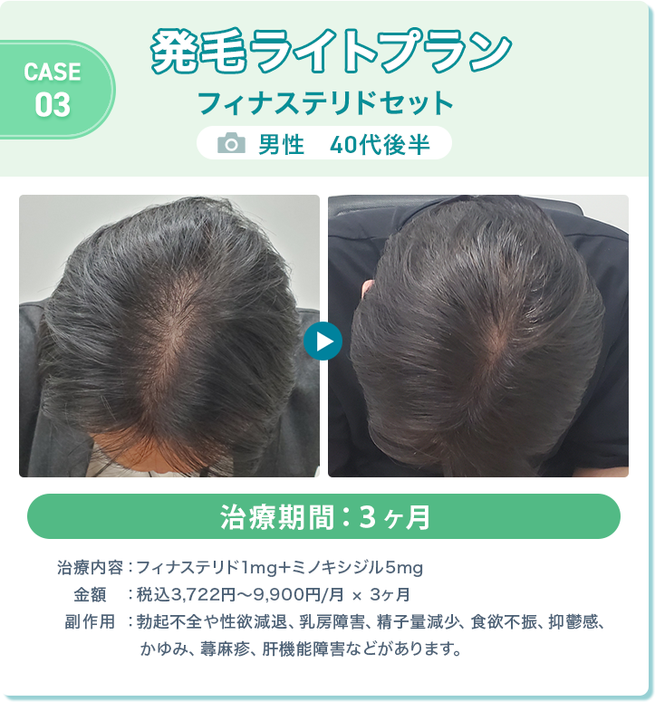 
				発毛ライトプラン フィナステリドセット
				男性　40代後半 
				治療期間：3ヶ月
				治療内容：フィナステリド1mg＋ミノキシジル5mg
				金額：税込3,722円〜9,900円/月 × 3ヶ月
				副作用：勃起不全や性欲減退、乳房障害、精子量減少、食欲不振、抑鬱感、かゆみ、蕁麻疹、肝機能障害などがあります。