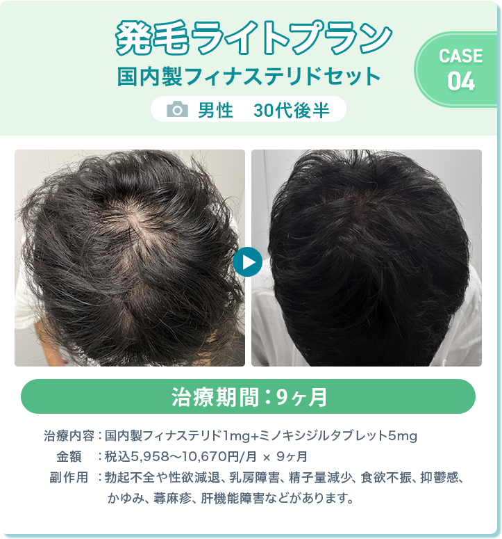 
				発毛ライトプラン 国内製フィナステリドセット
				男性　30代後半 
				治療期間：9ヶ月
				治療内容：国内製フィナステリド1mg+ミノキシジルタブレット5mg
				金額：税込5,958〜10,670円/月 × 9ヶ月
				副作用：勃起不全や性欲減退、乳房障害、精子量減少、食欲不振、抑鬱感、かゆみ、蕁麻疹、肝機能障害などがあります。