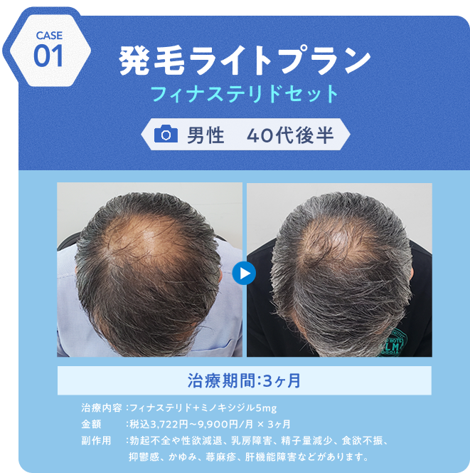 治療事例1 発毛ライトプランフィナステリドセット 男性40代後半 治療期間:3ヶ月