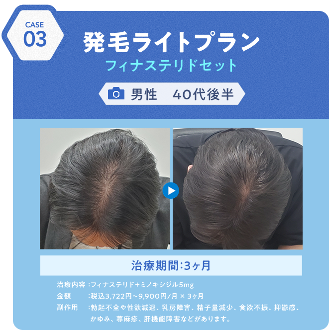 治療事例3 発毛ライトプランフィナステリドセット 男性40代後半 治療期間:3ヶ月
