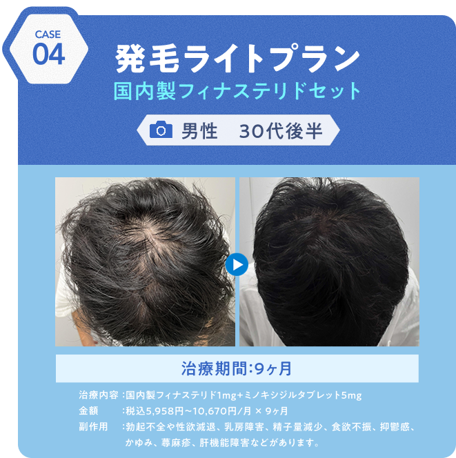 治療事例4 発毛ライトプラン国内製フィナステリドセット 男性30代後半 治療期間:9ヶ月