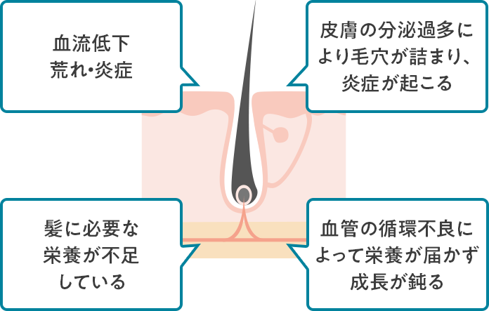 血流低下・荒れ・炎症　髪に必要な栄養が不足している　皮膚の分泌過多により毛穴がつまり、炎症が起こる　血管の循環不良によって栄養が届かず成長が鈍る