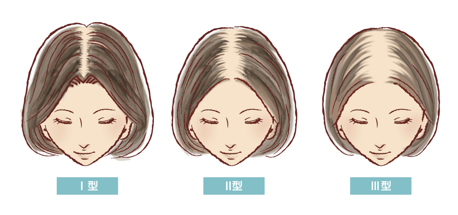女性AGAの進行イメージ